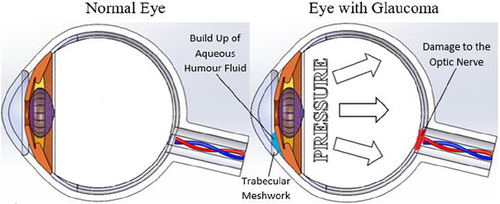 Okostelefonnal a zöldhályog ellen?